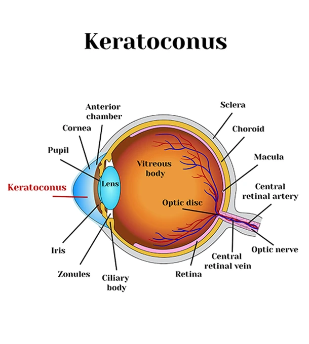 What is Keratoconus